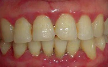 牙龈红肿牙周治疗[治疗前]
