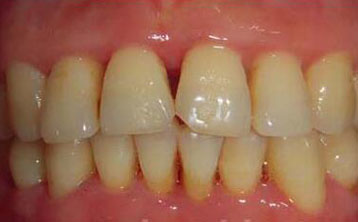 牙龈红肿牙周治疗[治疗后]