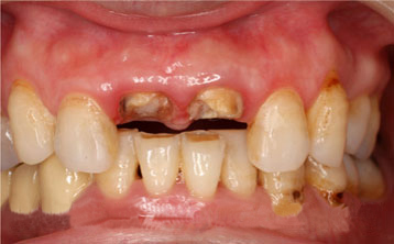 牙齿缺失全瓷冠修复[治疗前]
