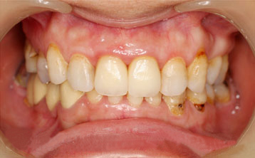 牙齿缺失全瓷冠修复[治疗后]