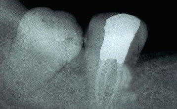 47牙C形根管器械折断取出[治疗后]