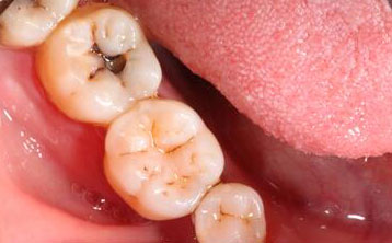 龋齿树脂补牙[治疗前]