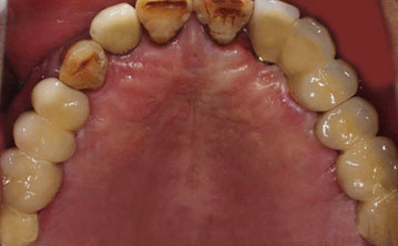 上颌多颗牙种植修复[治疗后]