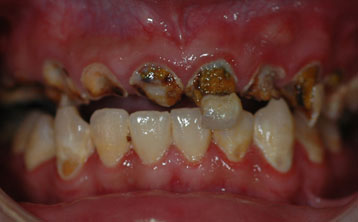 严重龋齿全口种植牙[治疗前]