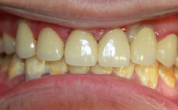 严重龋齿全口种植牙[治疗后]