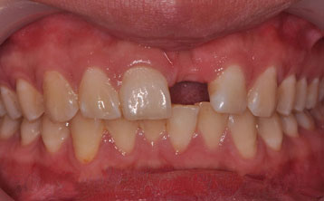 左上前牙缺失种植[治疗前]