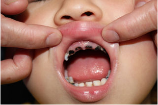 儿童蛀牙不治疗的五大危害