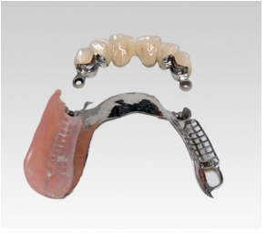 精密附着体义齿修复技术