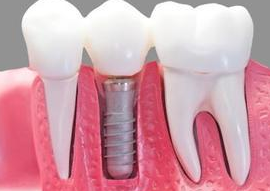 种植牙的过程是怎样的