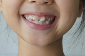 牙齿不齐是一种比较严重的口腔疾病