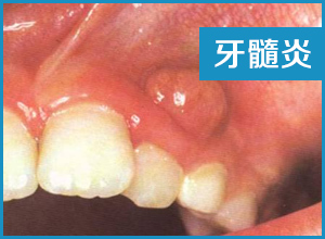 牙髓炎引起的牙齿疼痛该怎么办