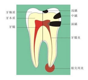 牙髓炎是由哪些原因形成的