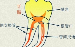 治疗牙髓炎有哪些方法