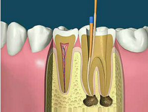 牙髓炎的诊断方法及治疗