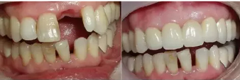 牙齿缺失会影响美貌吗