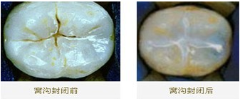 窝沟封闭可以一劳永逸吗