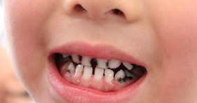 儿童蛀牙危害知多少