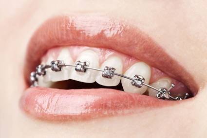 矫正牙齿使用自锁托槽的好处
