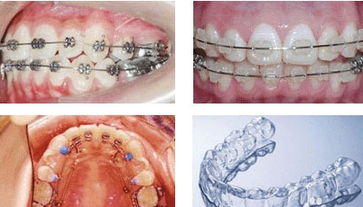 畸形牙矫正有哪几种方法