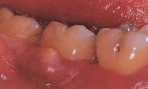 智齿牙痛的原因是什么