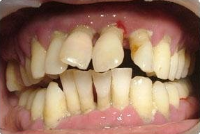 牙齿矫正期间的八大注意事项