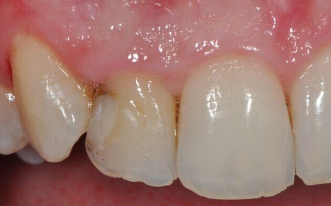前牙稀疏有哪些影响