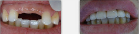 微创种植牙和常规植牙的主要区别