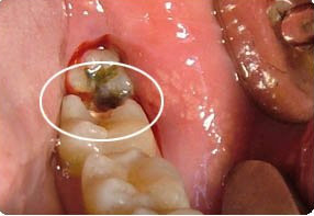 大部分的牙痛是龋齿引起的