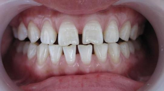 导致牙齿稀疏的原因有哪些