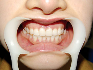 导致牙齿稀疏的原因有哪些