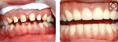 牙齿稀疏会有哪些危害