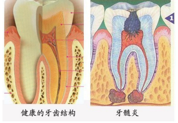 引起牙髓炎有哪几大因素？
