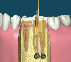根管治疗后，牙齿酸痛为什么