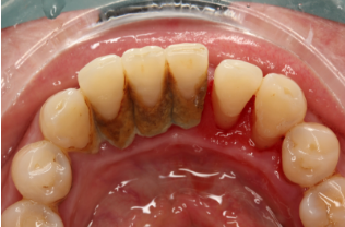 平时怎么注意预防牙周疾病呢