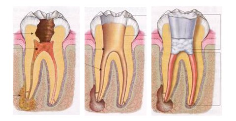 牙周病的治疗过程是怎样的
