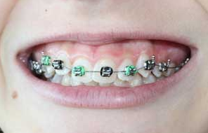 儿童牙齿矫正的方法有哪些