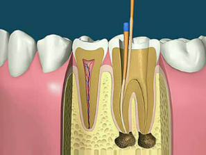 根管治牙是一项“救牙工程”