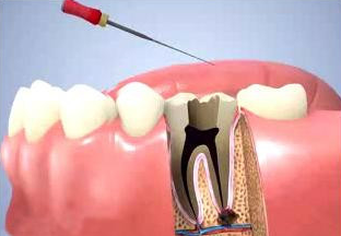 什么情况下做牙齿根管治疗