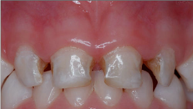 儿童患蛀牙有哪些危害