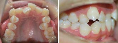牙齿错位有哪些表现
