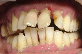 牙周病形成原因