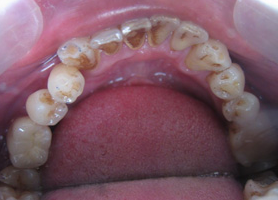 牙周病的预防和治疗