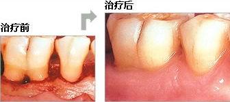 牙周基础治疗非常重要