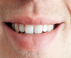 如何治疗牙齿美容