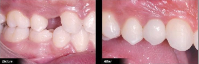 种植牙可能带来什么危害