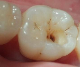 儿童伤牙的坏习惯有哪些