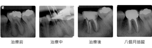 根管治疗期间能不能用牙吃饭