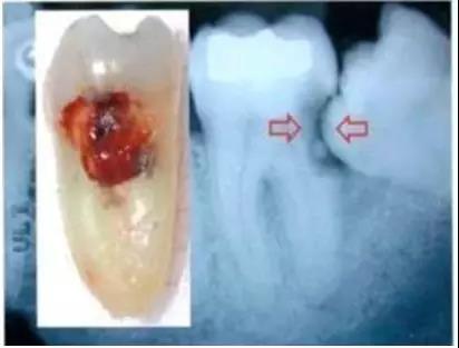 龋齿:智齿萌出位置不正,和前面的邻牙之间存在的间隙,成为天然