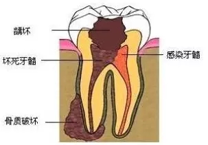 大牙坏了烂空了怎么办